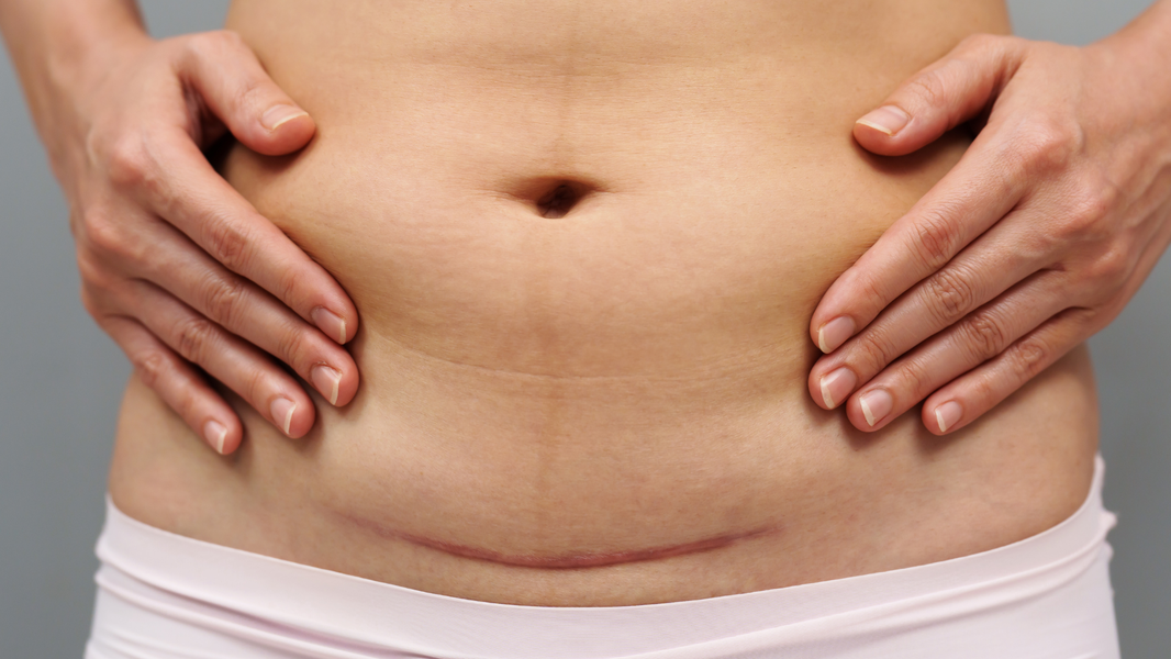 Step-by-Step Guide to C-Section Scar Desensitization and Mobilization