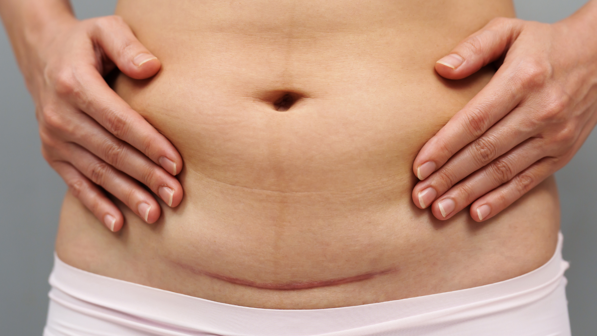 Step-by-Step Guide to C-Section Scar Desensitization and Mobilization